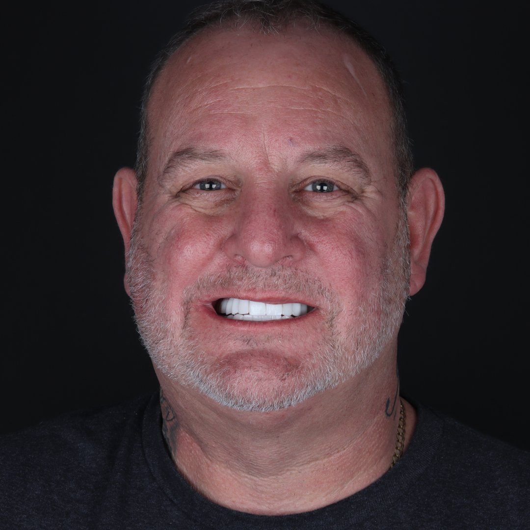 Transformative Journey: Leighton’s Smile Makeover Experience at AestheDental Dental Clinic