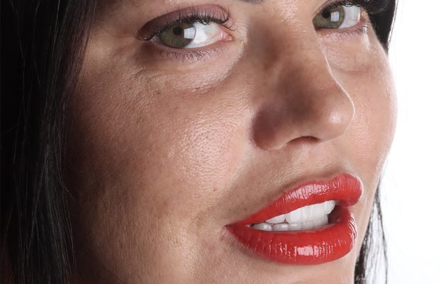 Yulia’s Smile Makeover in Antalya Turkey: A Story of Confidence and Happiness