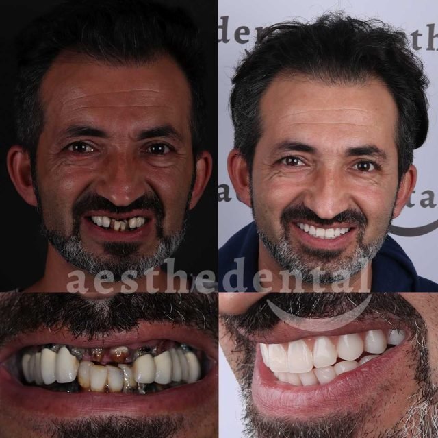 all-on-four-dental-implants