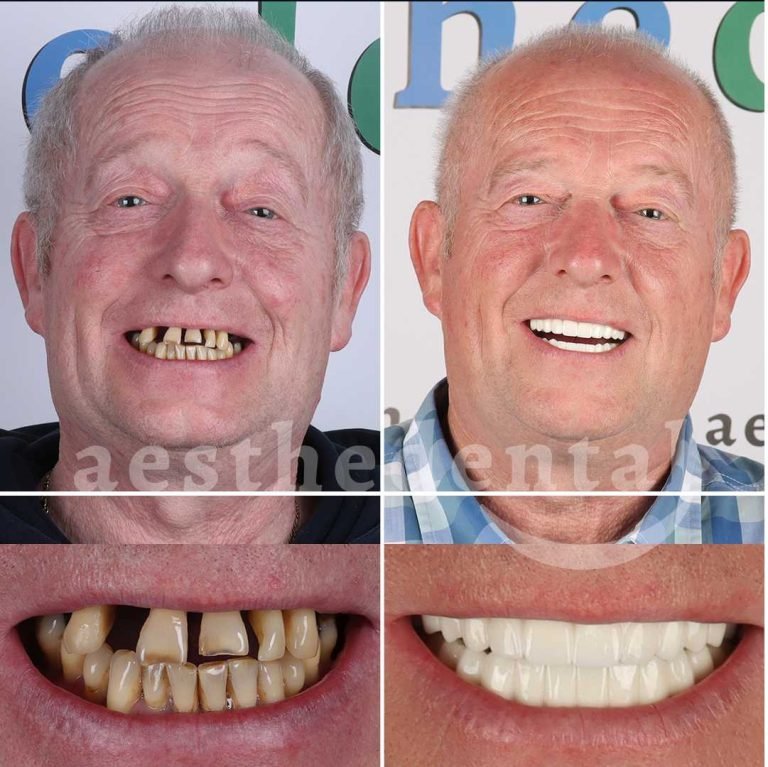 all-on-implants-turkey